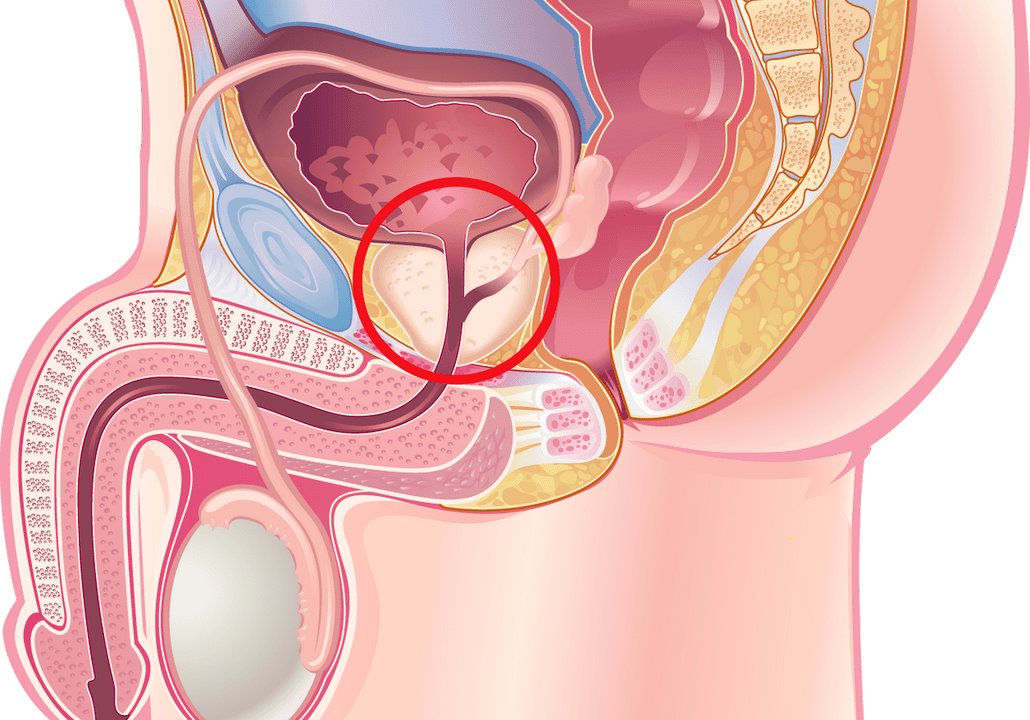 Symptomer an Unzeeche vun Prostatitis