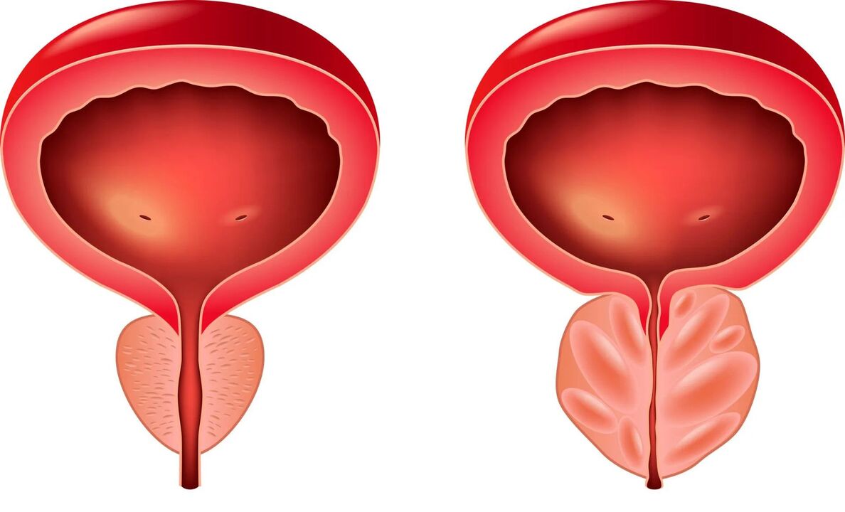 normal a krank Prostata