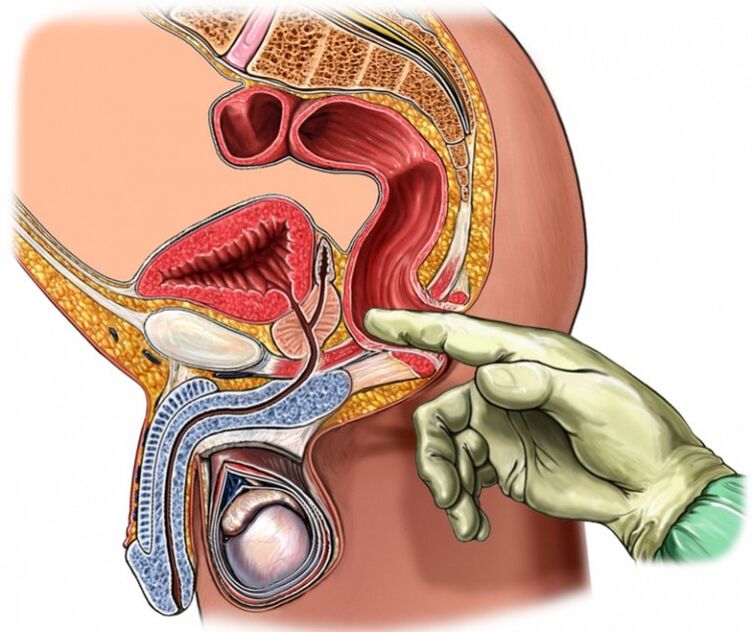 Prostatamassage fir Prostatitis