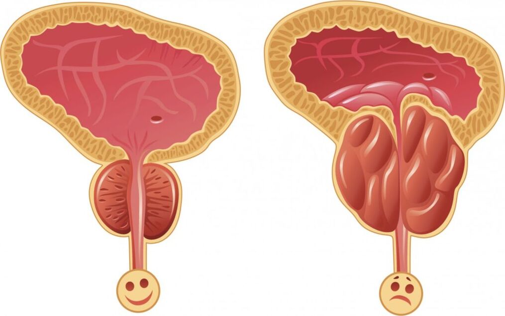 Symptomer vun Prostatitis bei Männer